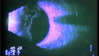 Ultrasound image showing detached vitreous gel