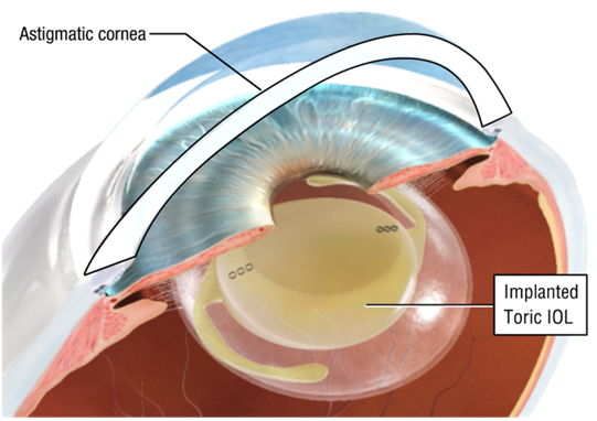 Refractive lens surgery