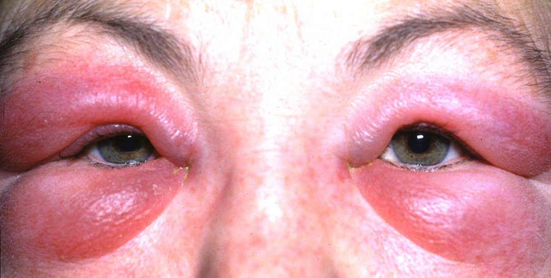 severe allergic reaction eye swelling